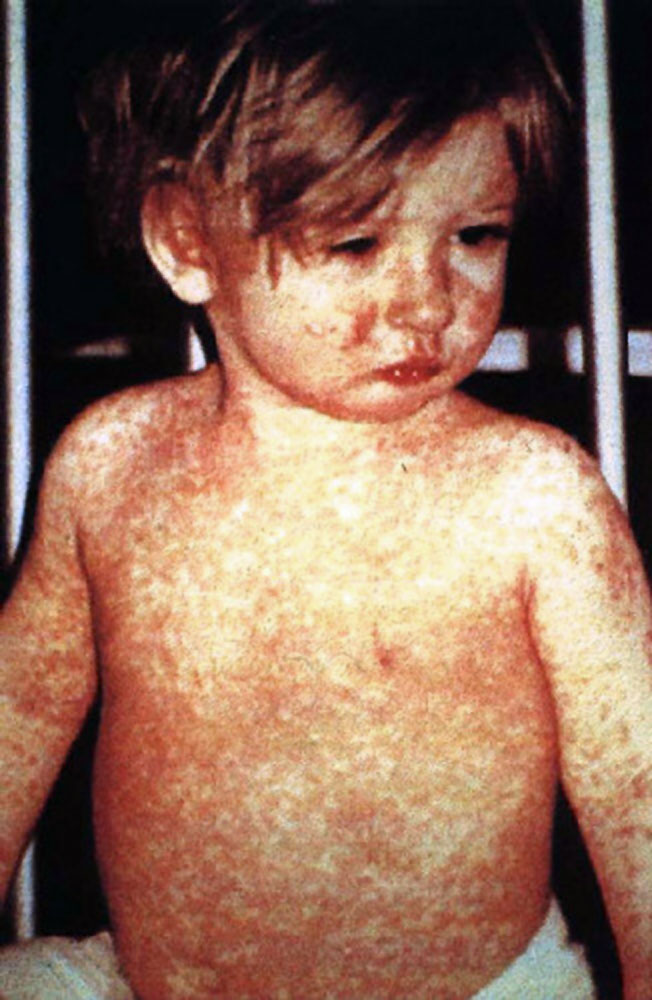 Child with measles: Not Al Gore’s fault. (CDC)