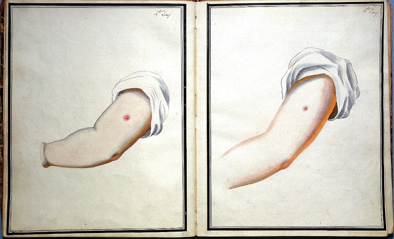 Drawing of smallpox and cowpox inoculation